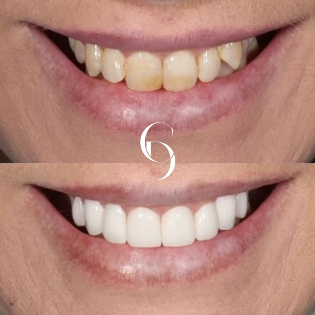 Porcelain Veneers Before And After