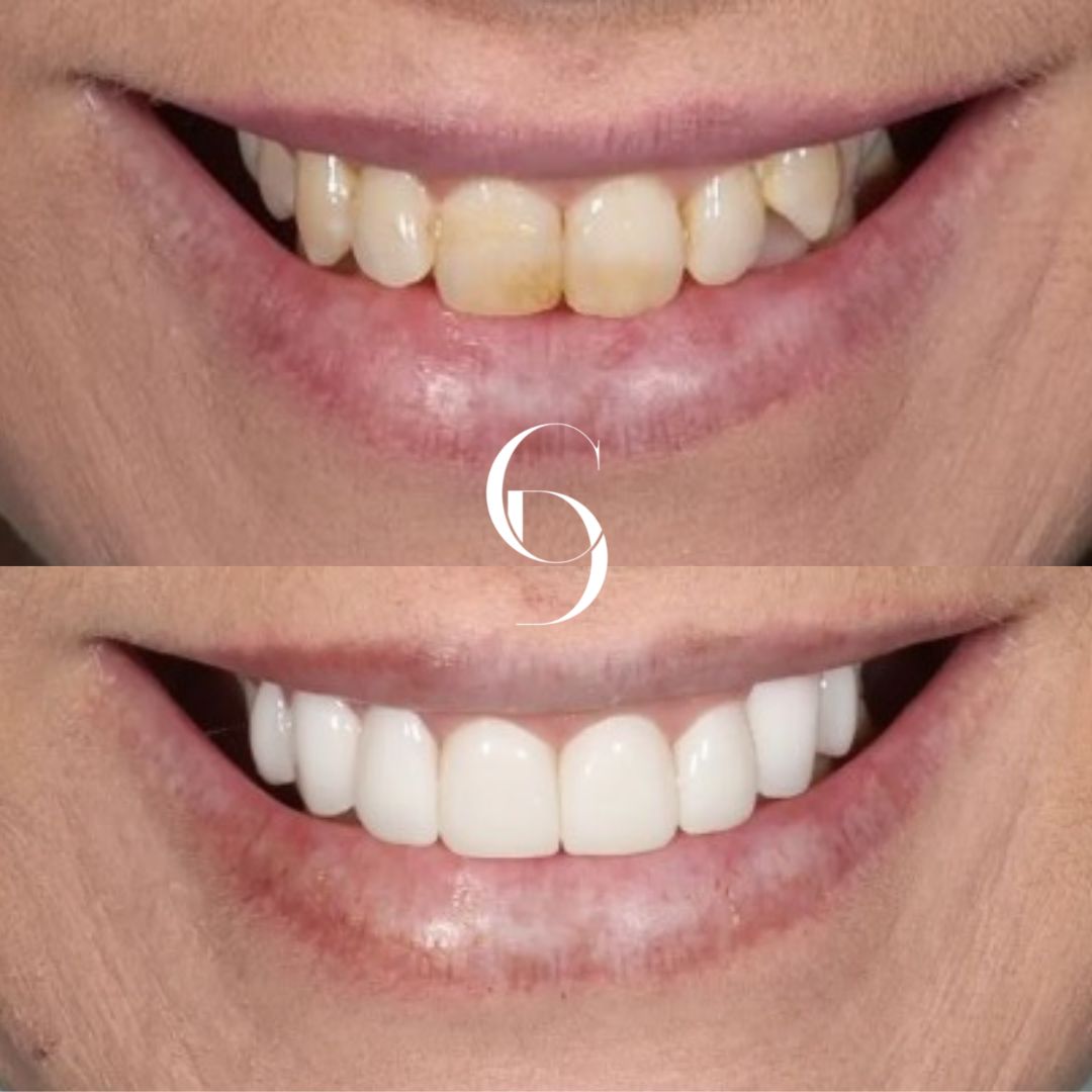 Porcelain Veneers Before And After