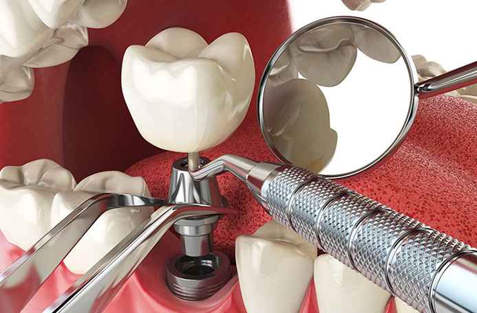 Dental Implants