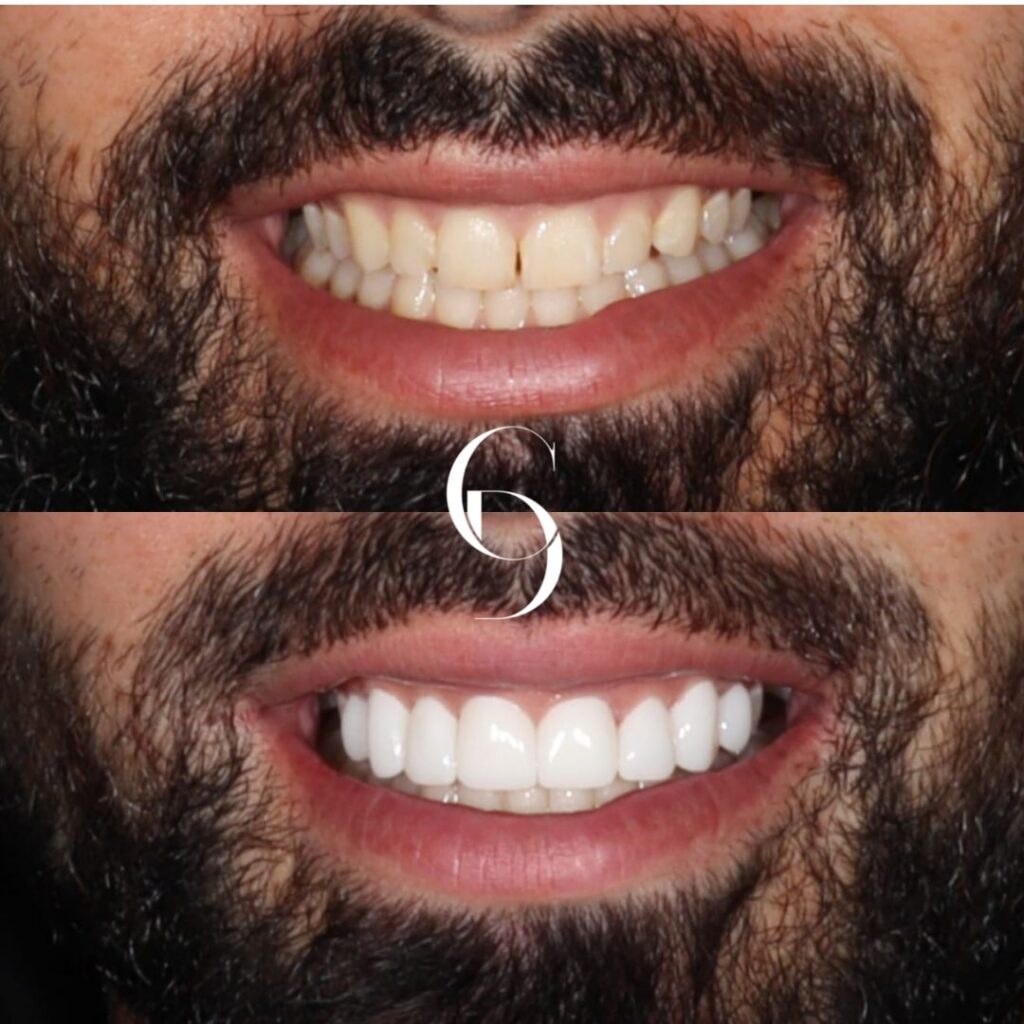 Porcelain Veneers