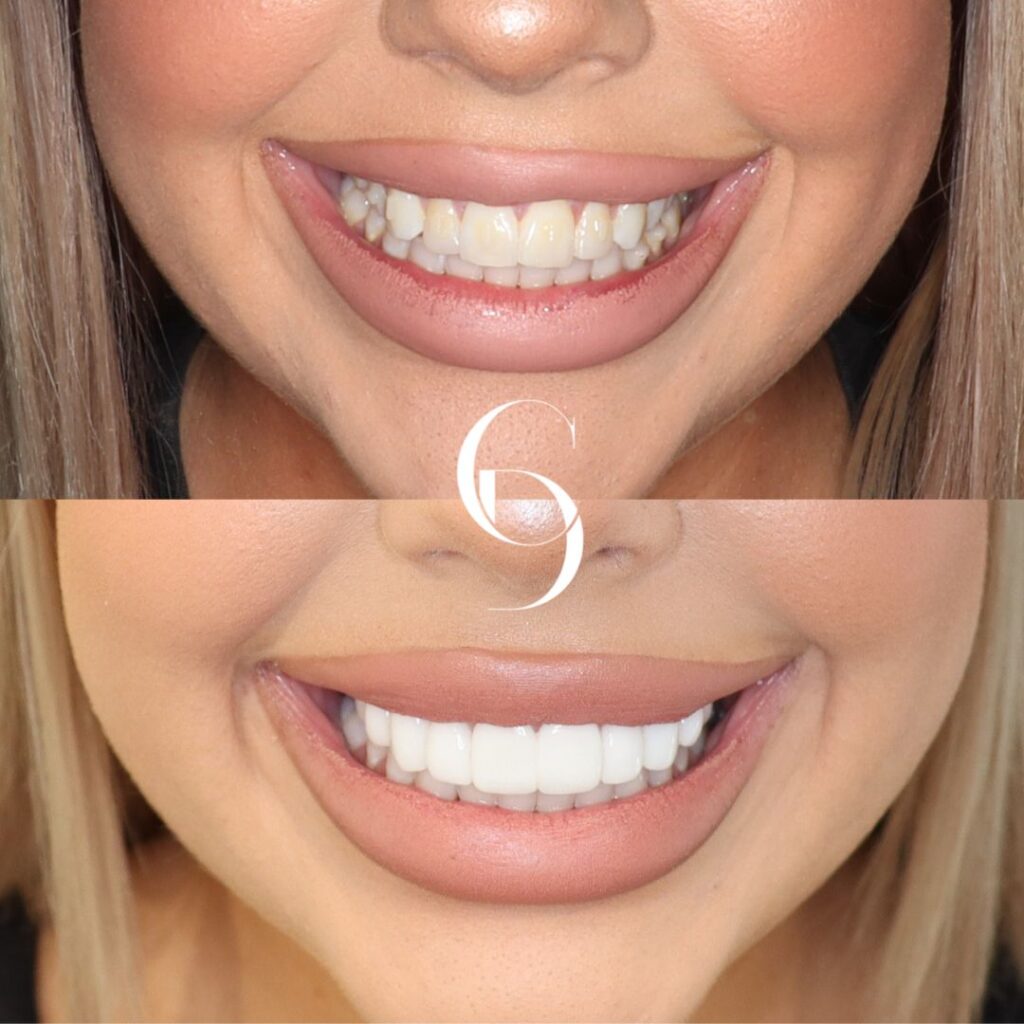 Porcelain Veneers