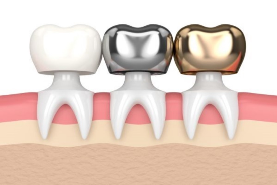 Dental crown cost Sydney