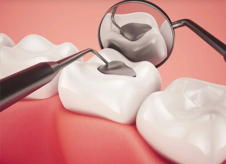 Which filling should I choose for my tooth? - Dentist in Sydney