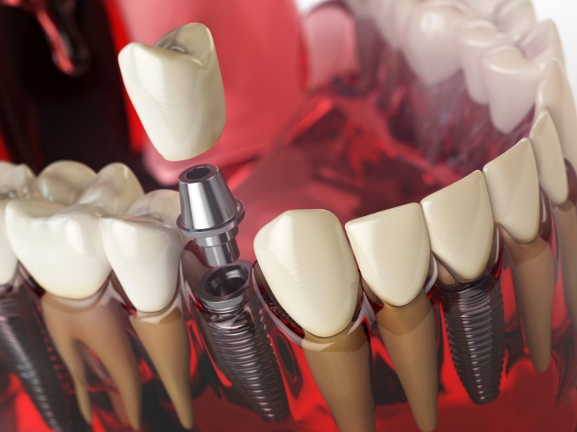 dental implant cost Sydney