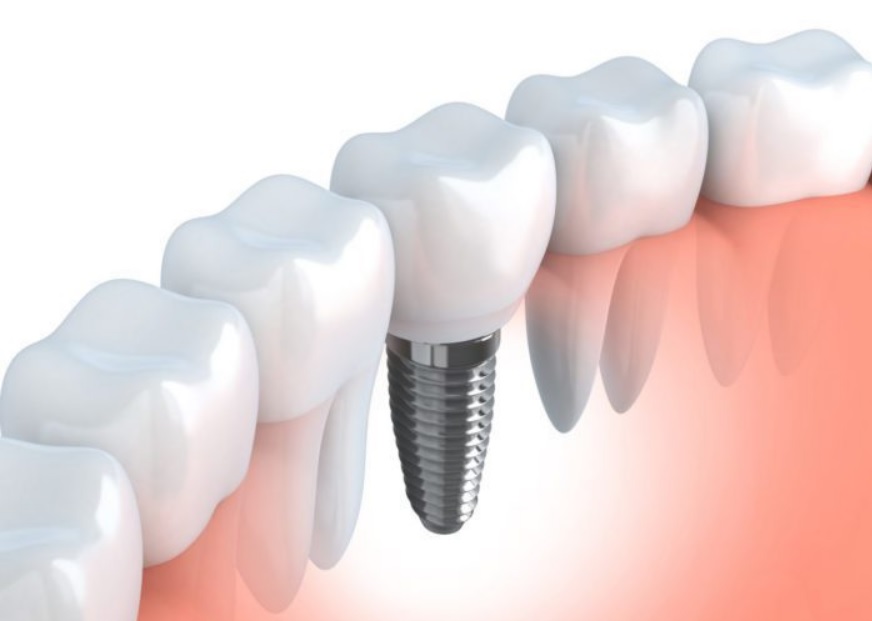 dental implant Sydney