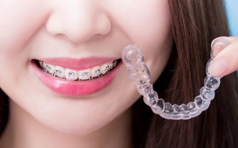 How Much Do Braces Cost? | Cosmetique Dental