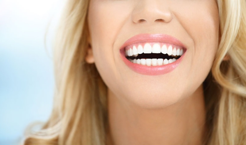 how much does teeth whitening cost Sydney