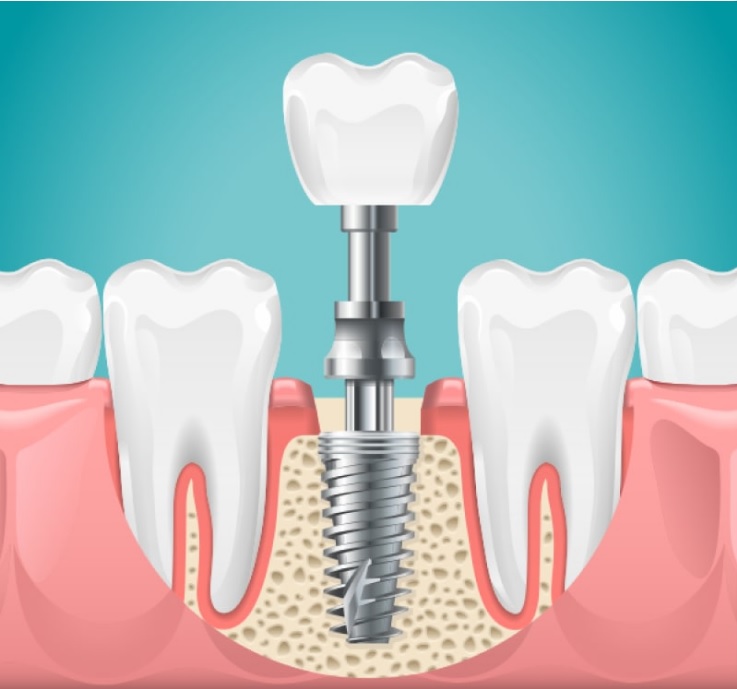 Teeth implants Sydney