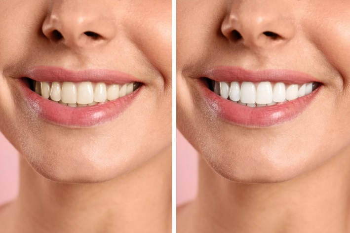Teeth whitening cost Sydney