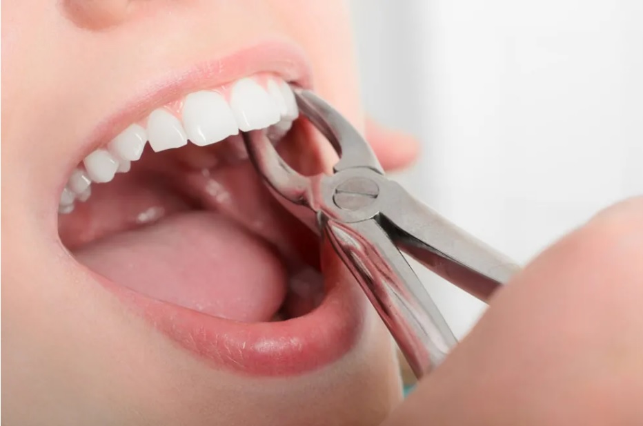 tooth extraction Sydney