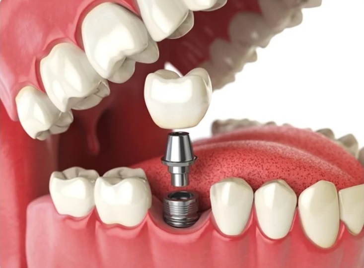 Tooth Implant Sydney