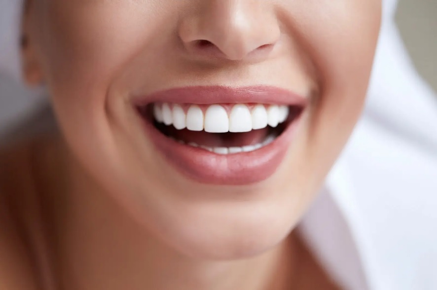 veneers for teeth Sydney