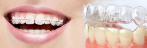 clear braces Sydney