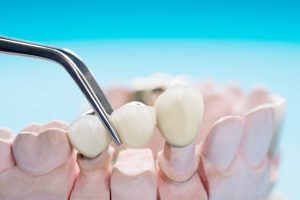 dental bridge cost