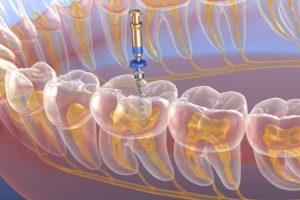 how much does a root canal cost