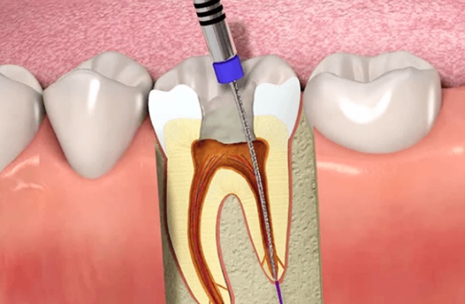 root canal cost Sydney