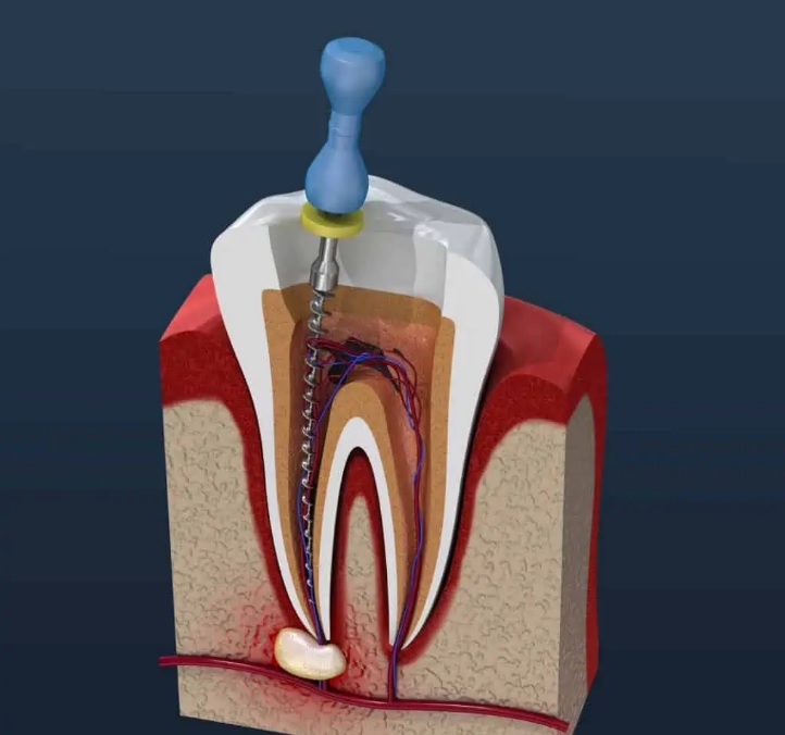 root canal treatment Sydney