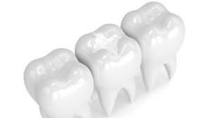 tooth filling Sydney