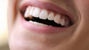 veneer teeth