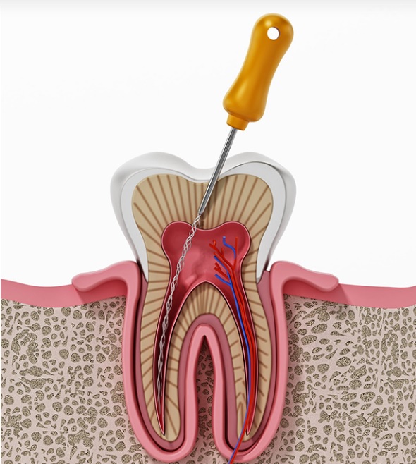 what is root canal