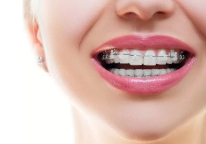 how much are braces in Sydney?
