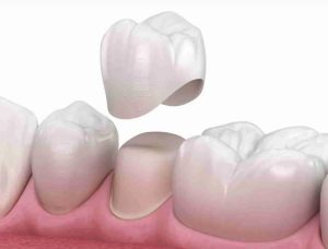 tooth cap Sydney
