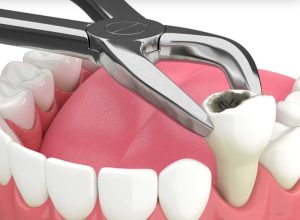 tooth removal Sydney