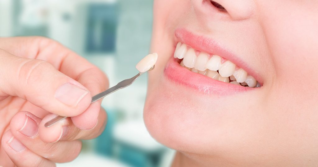 Important Things To Know Before Choosing Porcelain Veneers