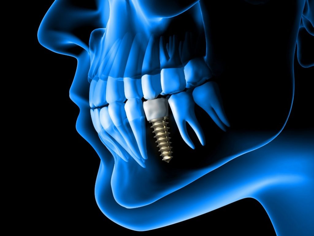 dental implant cost Sydney