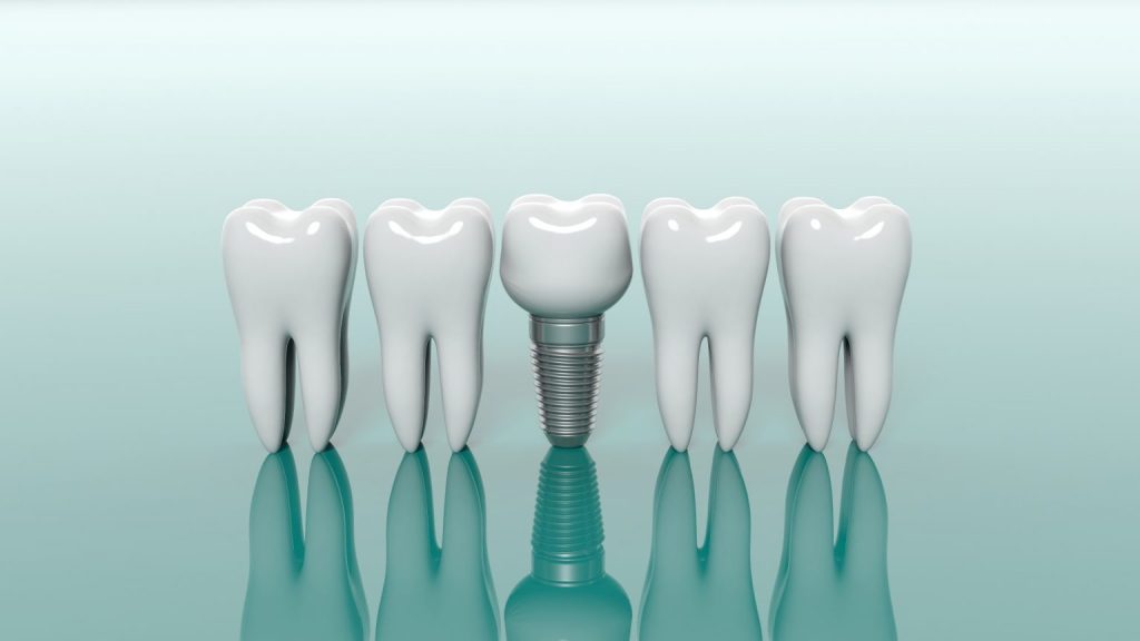 Important Tips To Increase The Longevity of Dental Implants