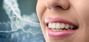 Things You Need To Know Before Getting Invisalign