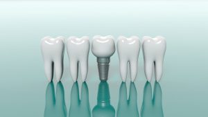 Dental Bridge or Dental Implants Which Should I Choose