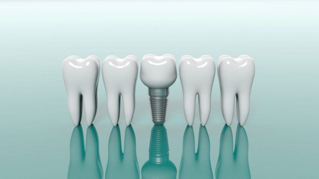 Dental Bridge or Dental Implants | Which Should I Choose?