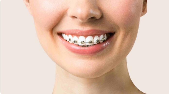 Different types of Braces