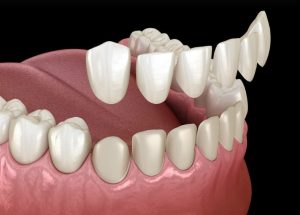Do Veneers Protect Your Teeth?