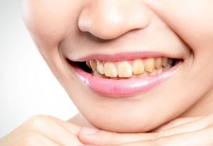 Symptoms and Side Effects of Teeth Grinding: How to Stop Teeth Grinding