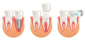 Dental Veneers vs. Crowns or Implants - Which One is Better?