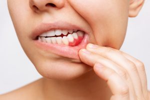 Symptoms of Unhealthy Gums and Their Diseases Possibilities