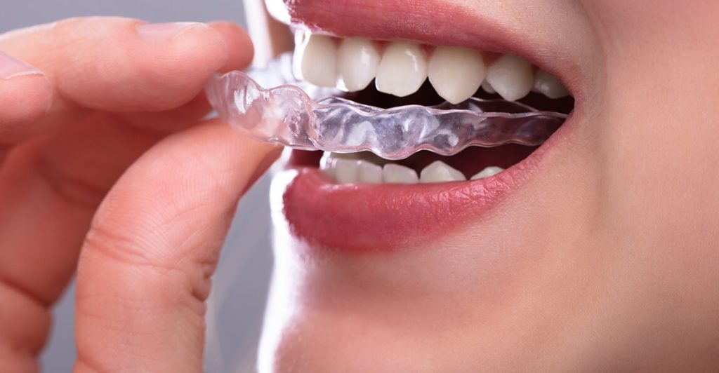 Can Invisalign fix crowded teeth