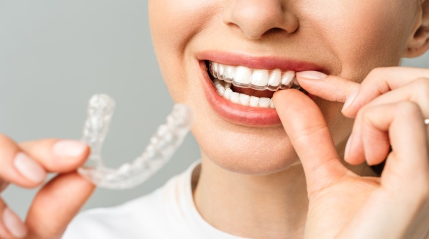 Invisalign Cost Canberra