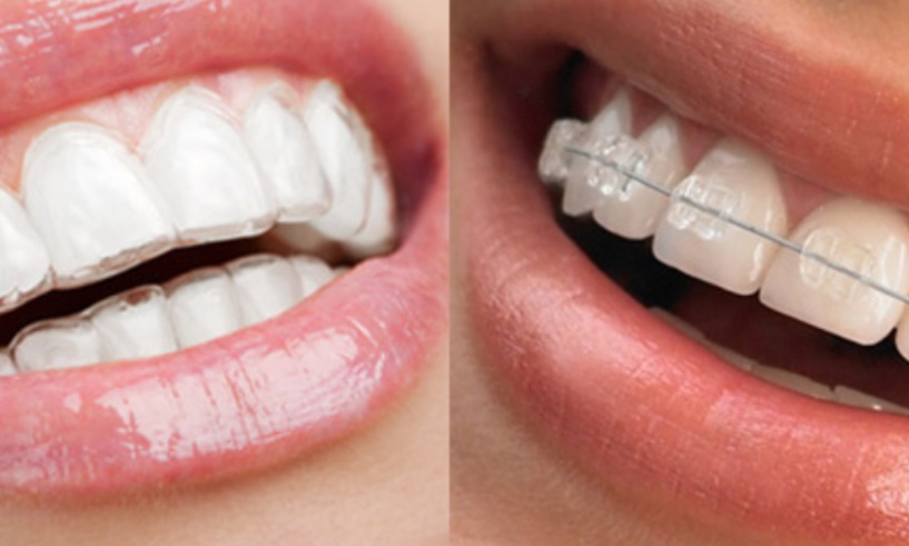 Is Invisalign Better Than Braces
