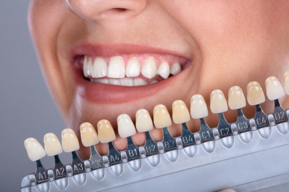 Porcelain Veneers Shades