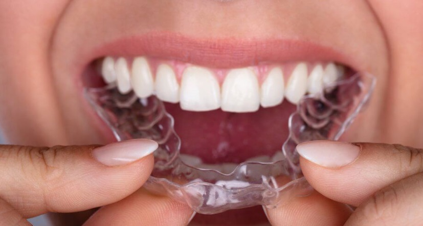 What is Invisalign?