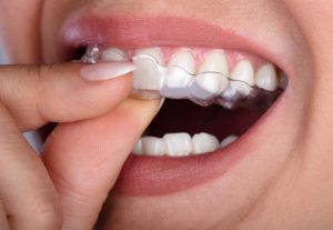 How Long Does Invisalign Take