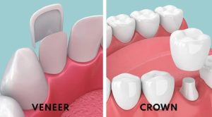 Porcelain Crowns vs Porcelain Veneers