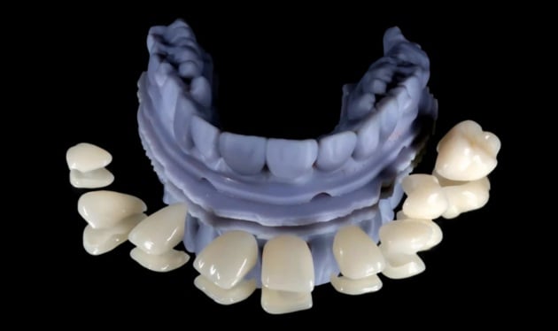 Porcelain Veneers Sydney Canberra dental veneers North Sydney, Sydney CBD, Bondi Junction, Parramatta, Macquarie Park, Hornsby