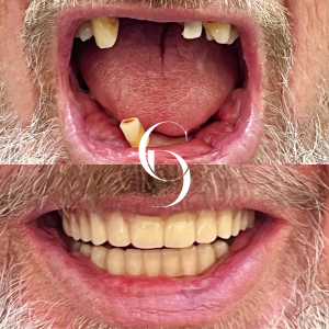 all-on-4-dental-implant-before-and-after