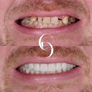 all-on-x-dental-implant-before-and-after