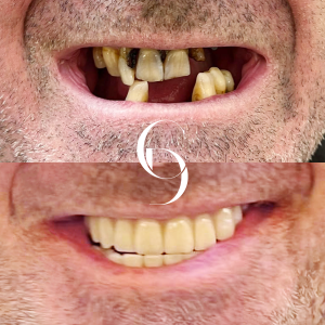 all-on-x-implant-before-and-after