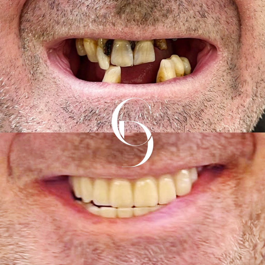 All-on-4 Implants
